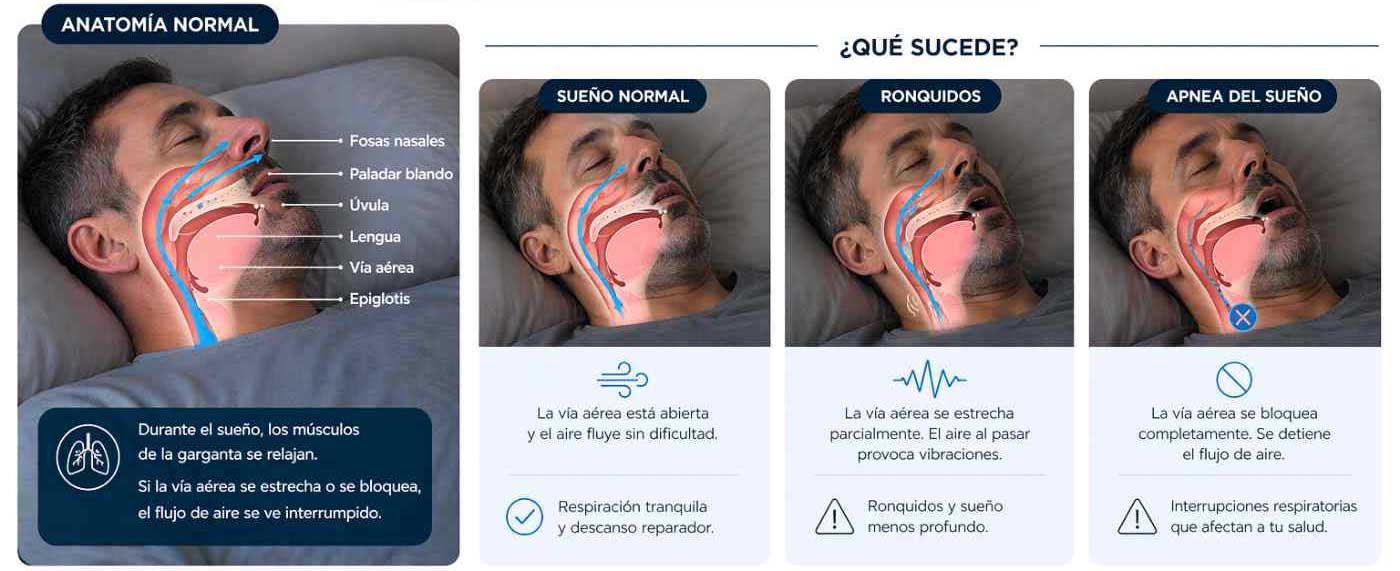Así evoluciona un episodio de apnea